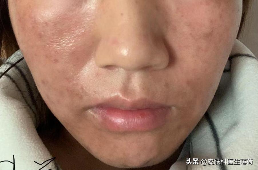 刷酸用果酸还是水杨酸,医生不会告诉你祛脚气的秘密