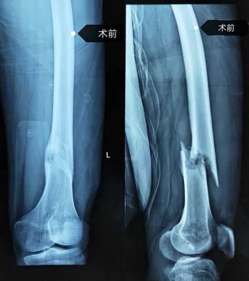 颅底骨折3d打印,3d打印技术辅助治疗胫骨平台骨折
