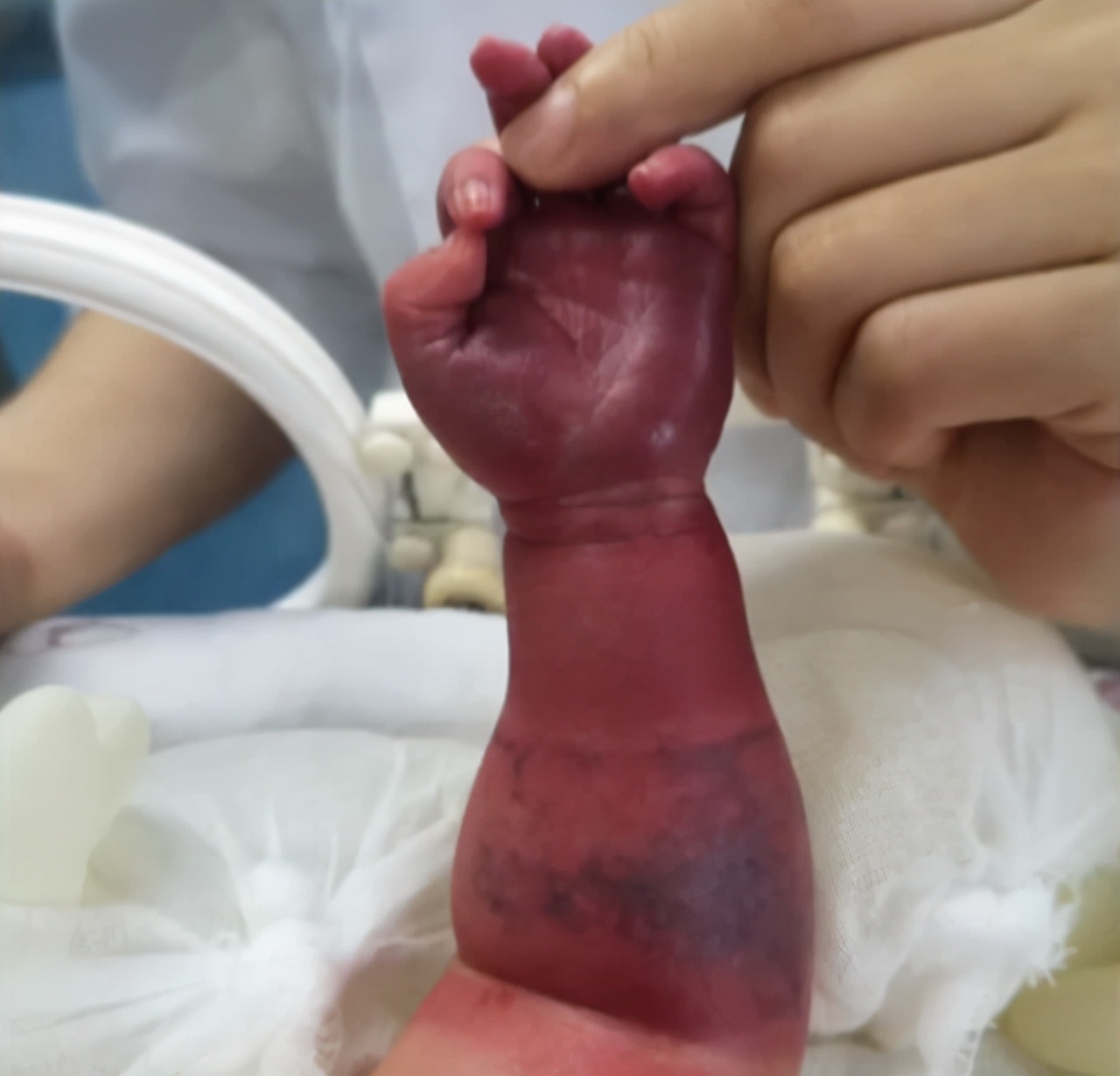 婴儿胳膊突然肿了,宝宝手臂肿了一块鼓起来