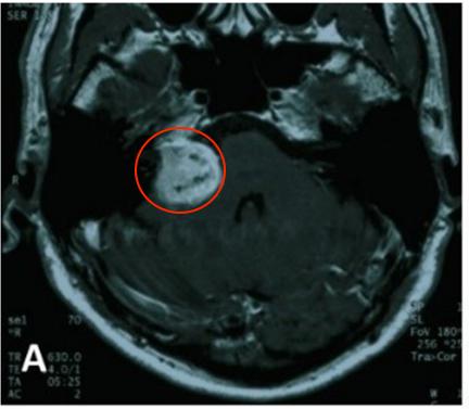 听神经瘤复发做二次手术,听神经瘤复发能要命吗