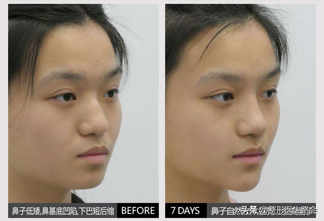 韩式隆鼻是不是就是单纯隆鼻,韩式隆鼻一般要多少钱一次案例