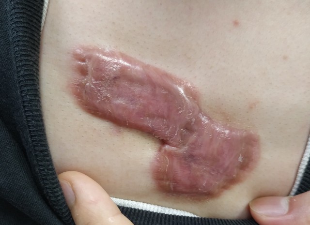 疤痕边缘凸起怎么办,手术二年多疤痕凸起发红且痛