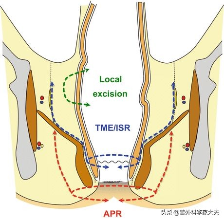 直肠癌保肛手术后疼痛是怎么回事,直肠癌保肛术后肛门痛用什么药