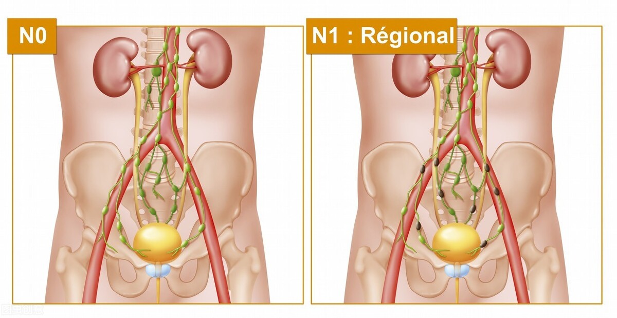 尿急尿频经常反复,经常尿急尿频是结石一直没下来吗