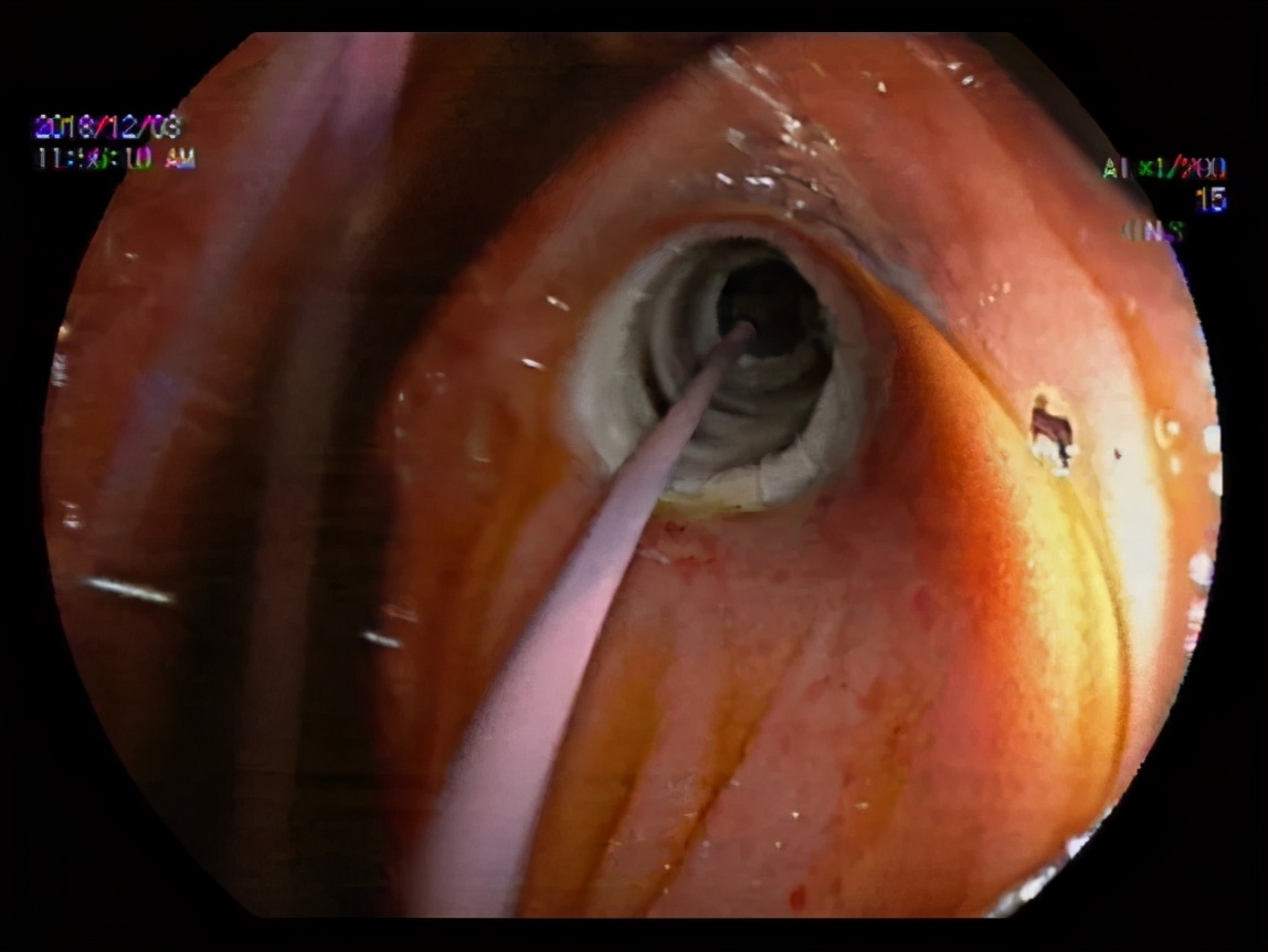 八年胆汁流通不畅，老奶奶成了“小黄人”……