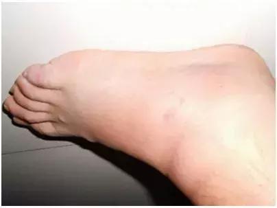 扭伤拉伤处置,扭伤拉伤治疗手法