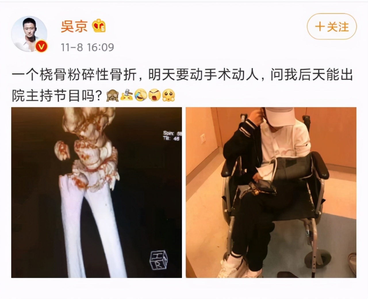 谢楠骨折要动手术，X光照可见明显碎骨，医生：高*力暴**损伤所致