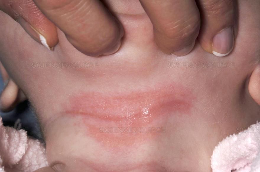 夏季皮肤瘙痒长痱子怎么整,夏季婴儿穿尿不湿有痱子怎么办