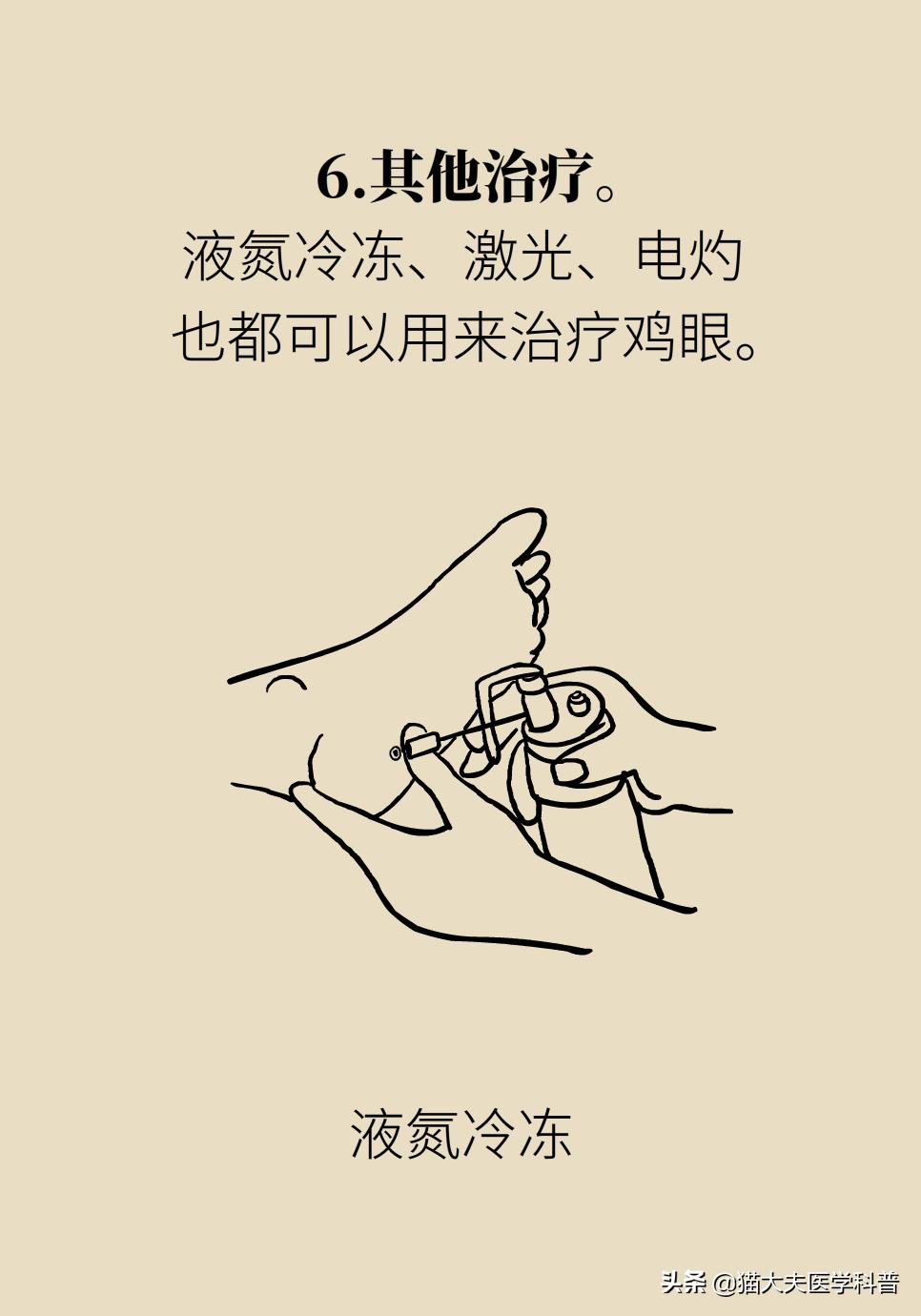 鸡眼好了长了一层老茧,鸡眼与老茧的区别图片