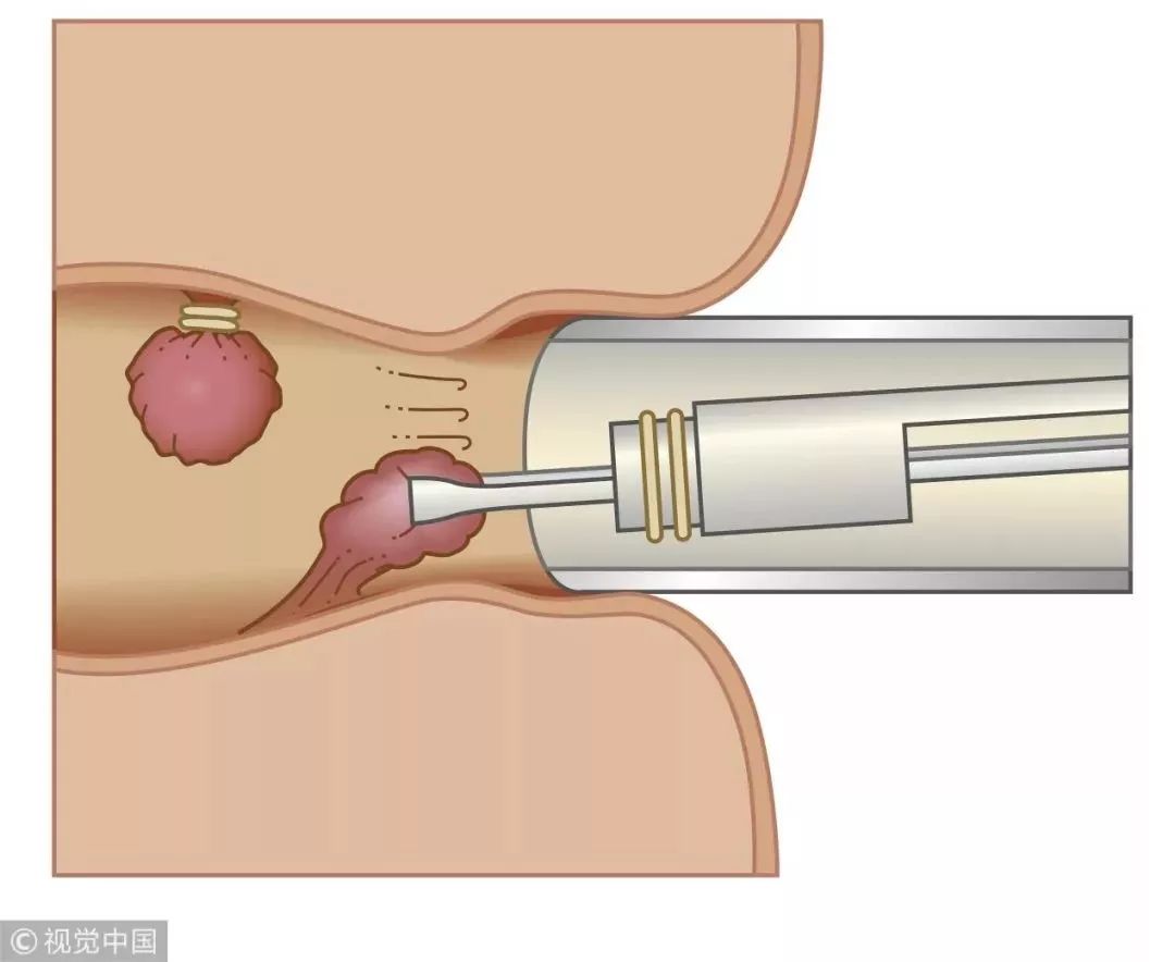 “十人九痔”，必须重视！4个妙招助你远离痔疮，早知道少遭罪