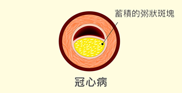 为啥得心脏病,为什么得心脏病的人越来越多