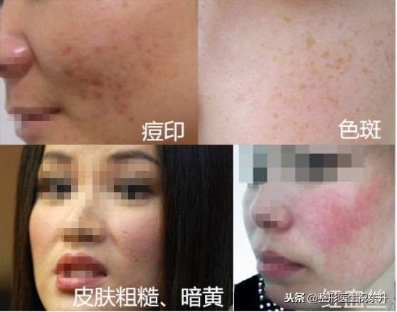 光子嫩肤敏感皮肤能做吗,光子嫩肤做了皮肤敏感