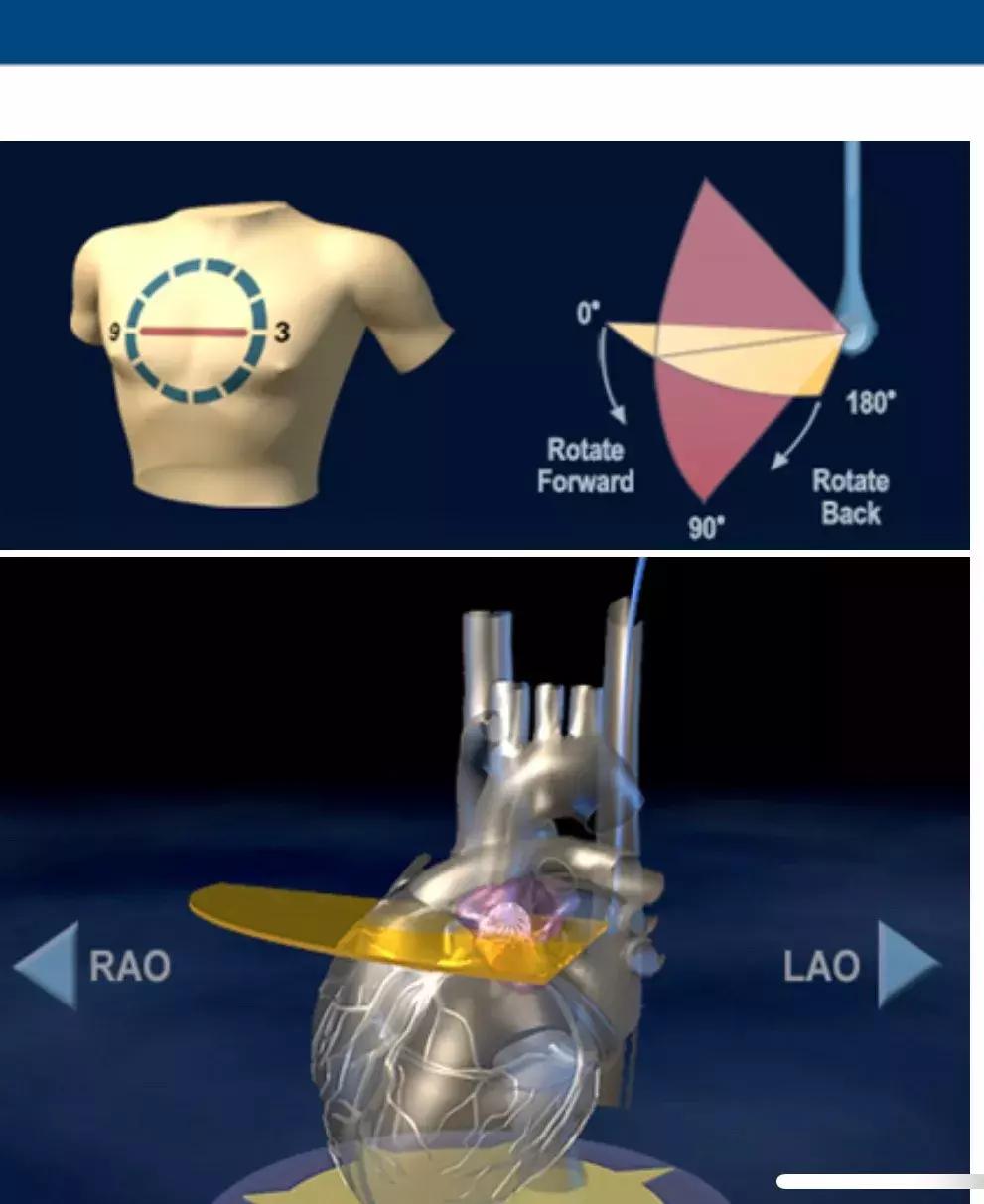 房颤与食道超声,经食管超声心动图能检查出房颤吗