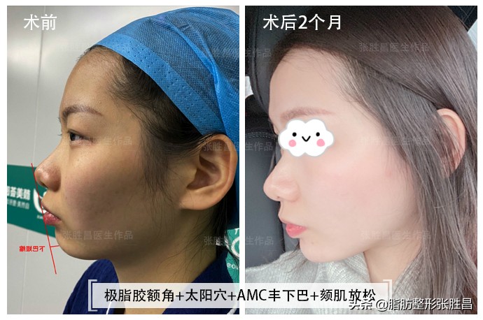 下巴后缩但不想脸变长,下巴后缩不想正颌只想整齐