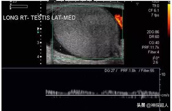 男性“蛋蛋”痛，必须引起重视，特别是一侧突发痛