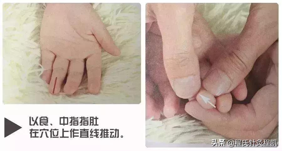 小儿荨麻疹中医反射推拿,荨麻疹夏季如何预防虫咬皮炎