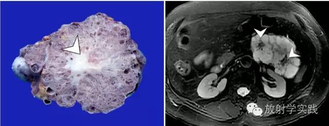 胰腺尾部肿块怎么判断,胰腺精准治疗