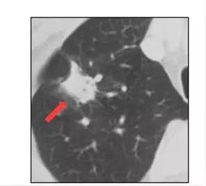 磨玻璃肺结节17mm要不要马上手术,7毫米肺磨玻璃结节要不要切除