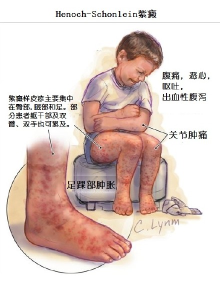 过敏性紫癜反复发作怎么办,这三种方法“任你挑选”