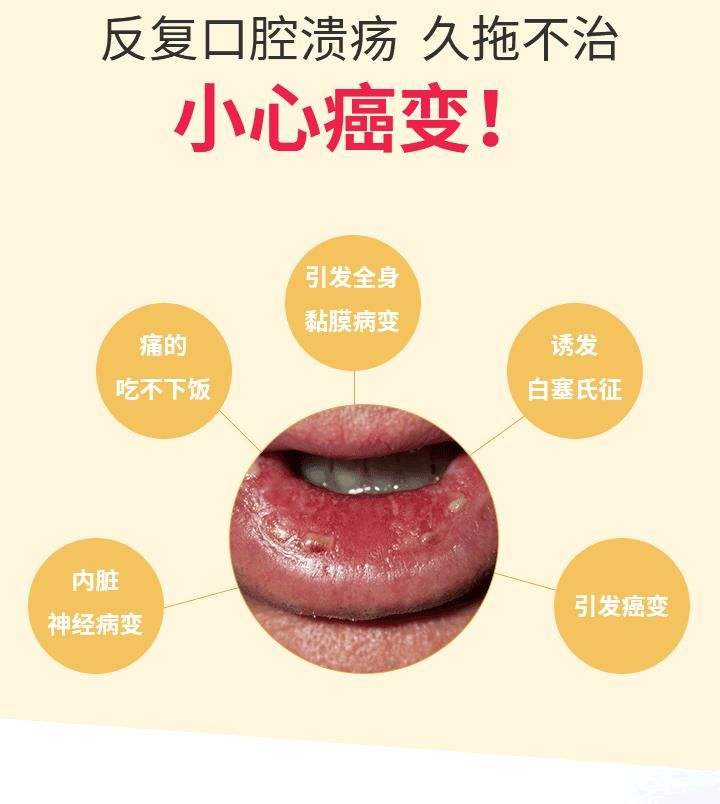 最全面的口腔溃疡治疗方法详解,怎么快速治愈严重口腔溃疡