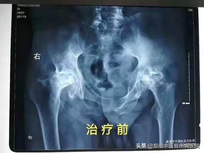 沈阳股骨头坏死患者视频,股骨头坏死沈阳保守治疗