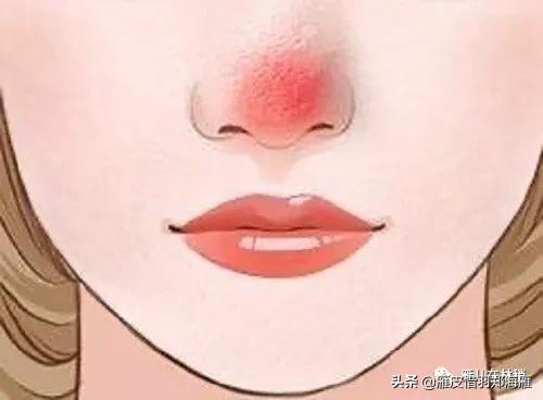 认识痘痘类型,玫瑰痤疮和激素脸哪个严重