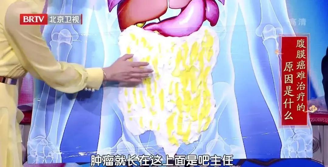 腹膜癌有什么特征,腹膜型恶性肿瘤