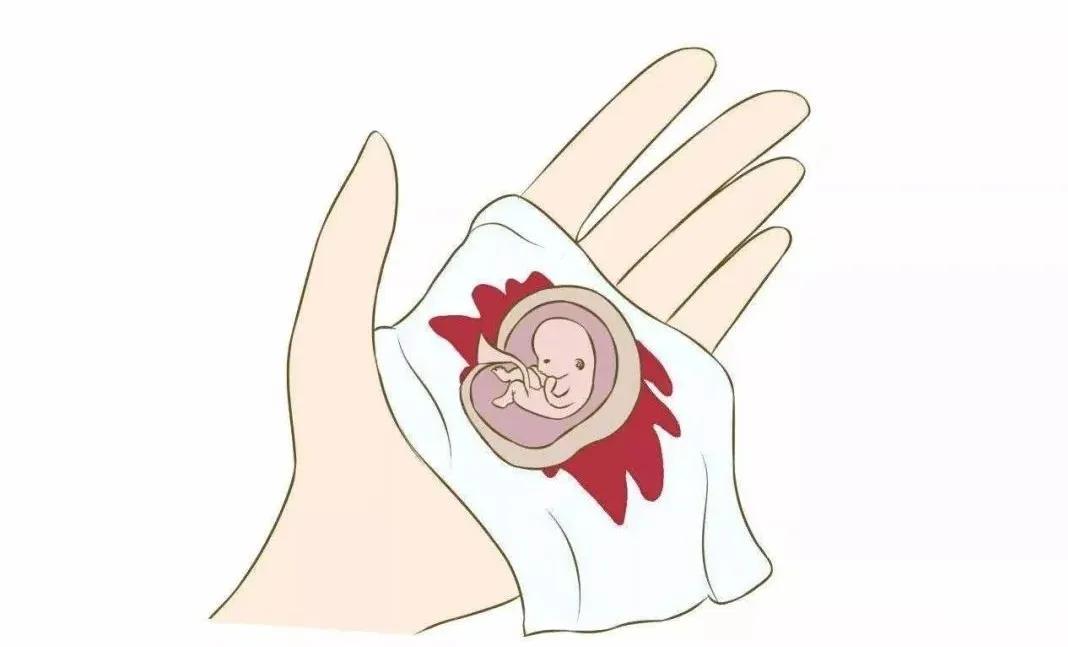 自己买堕胎药堕胎几率大吗,自己去医院堕胎