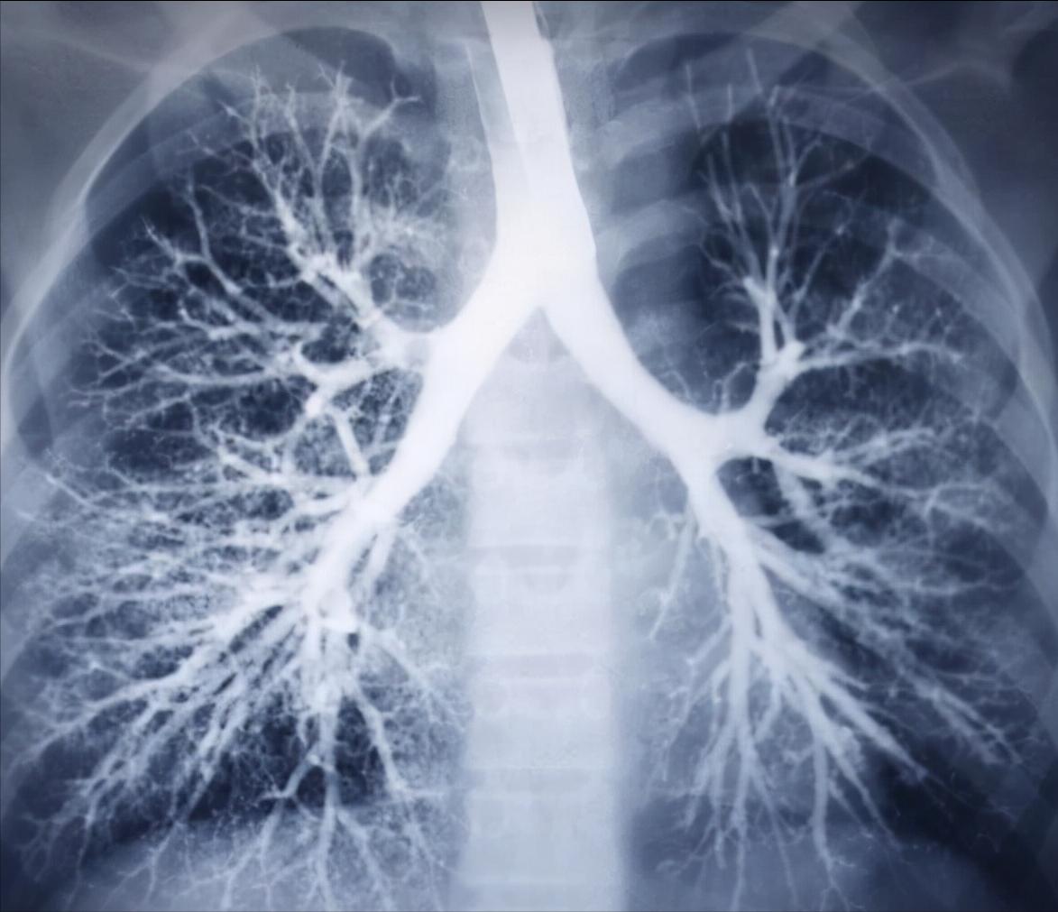 肺纹理增多增粗需做ct吗,肺纹理稀疏和纹理增粗哪种严重些