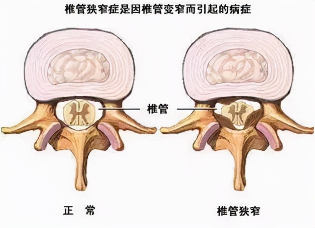 腿痛无力?走路不稳?出现走路问题怎么区别胸椎狭窄or腰椎狭窄?