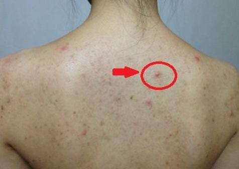 四种螨虫都是什么螨虫,皮肤上有螨虫的表现