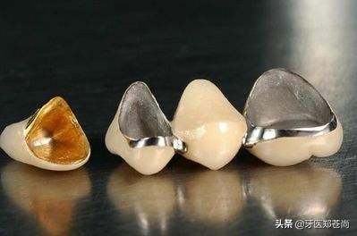 爱尔兰烤瓷牙好吗,烤瓷牙到底好不好用