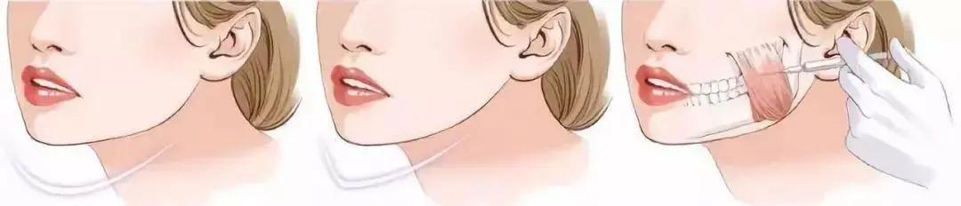 瘦脸针针对性提拉你的脸型适合吗,打完瘦脸针凹陷下垂脸型变得难看