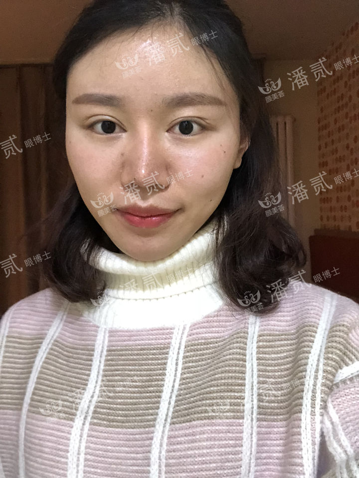 开眼角过大图片,开眼角过大修复效果图