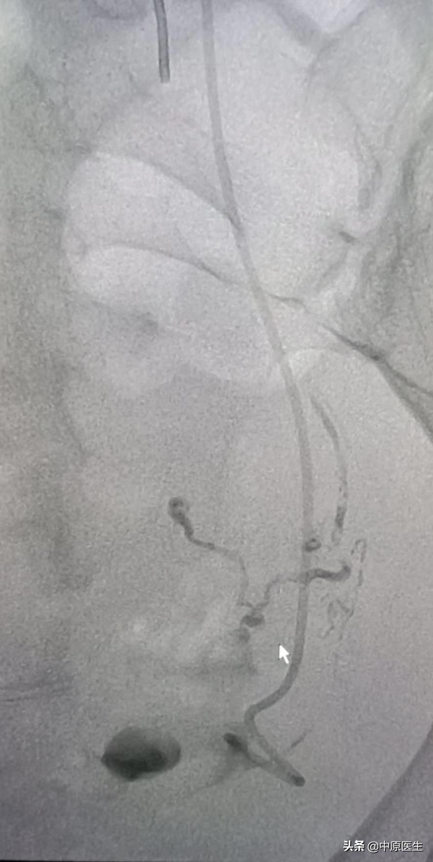鎴戝湪鏂板啝鐤儏涓殑缁忓巻,鍦ㄦ柊鍐犵柅鎯呮劅鏌撲笅鐨勬垜