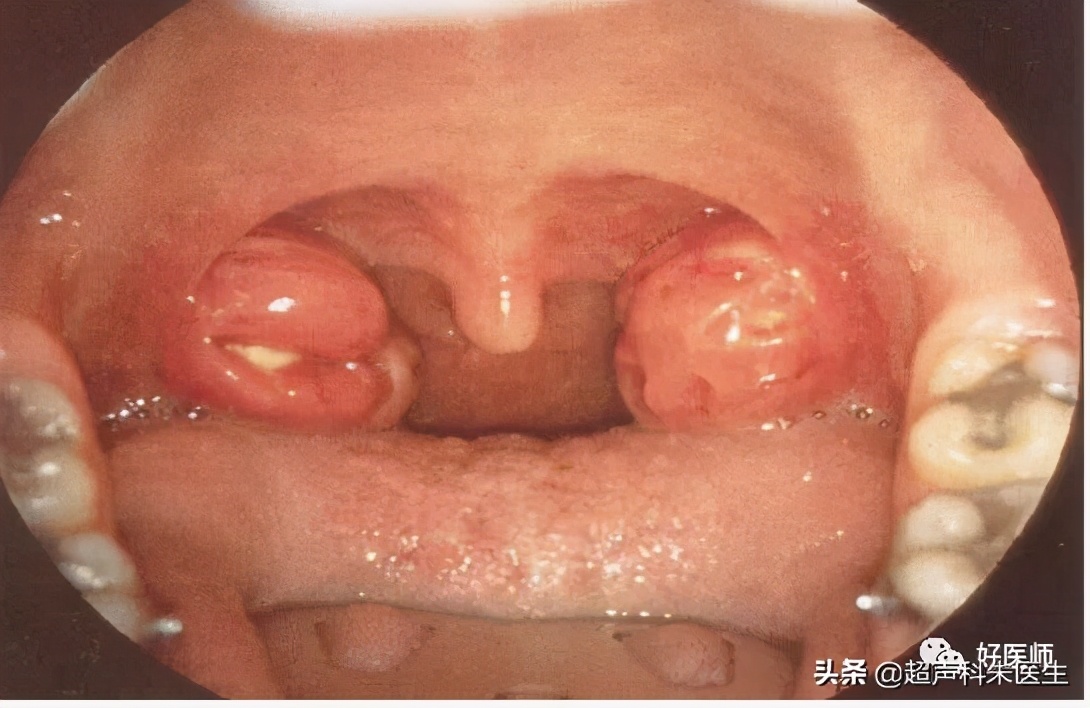 咽喉疾病科普知识,咽喉疾病动画科普视频