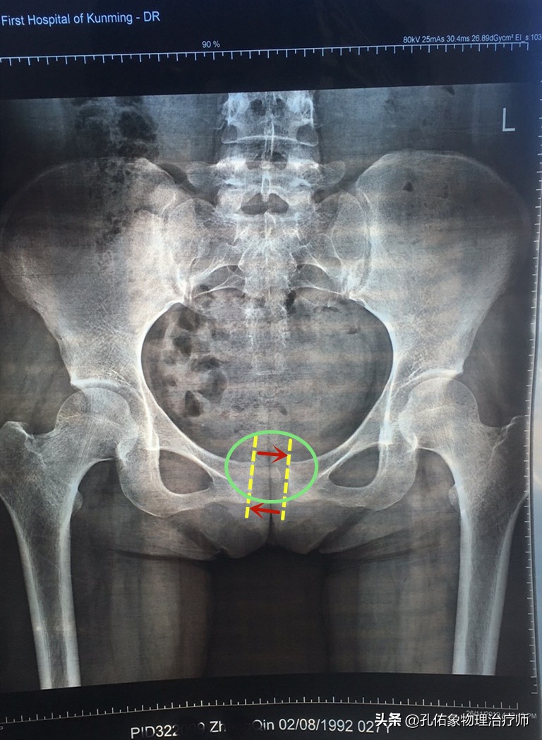 女性为什么大腿根会痛,中年女性大腿内侧疼痛是怎么回事