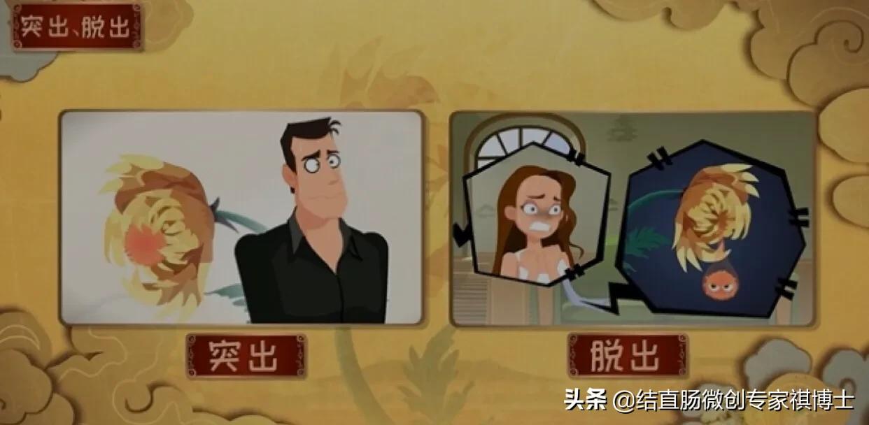 什么是混合痔疮的症状,女性痔疮和脱肛的症状