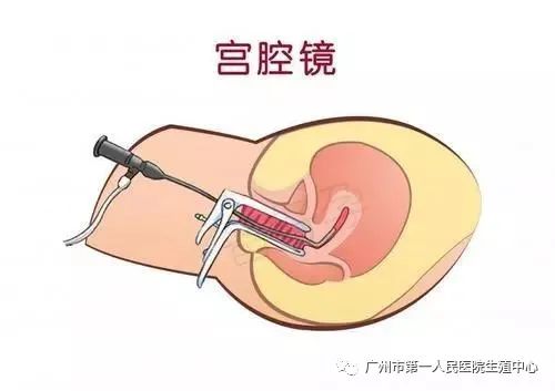 反复流产需要查输卵管造影吗,反复宫腔粘连还要继续宫腔镜吗