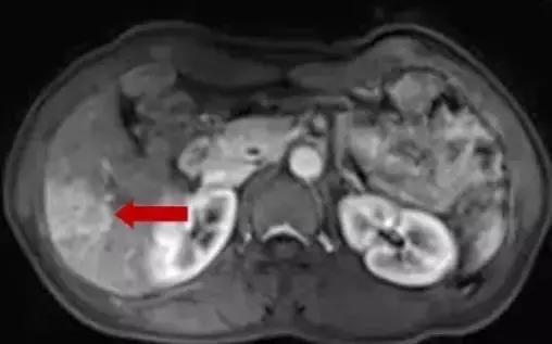 肝转移瘤射频消融生存期,肝内多发肿瘤可以射频消融吗