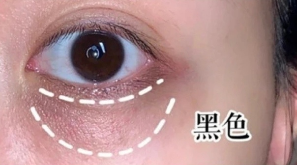 长了黑眼圈怎么办,没熬夜为什么长黑眼圈