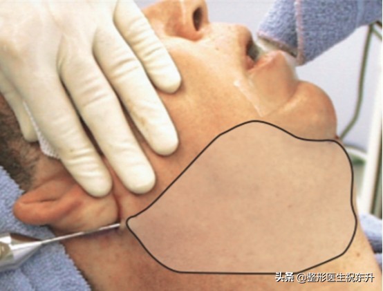 下颌线吸脂变化,双下巴下颌线吸脂对比图