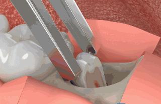 牙齿矫正的九大常见误区,牙齿矫正之七大误区