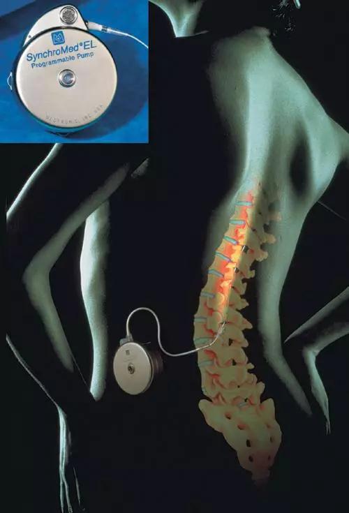 骶神经刺激器植入术效果,全面开展神经调控技术