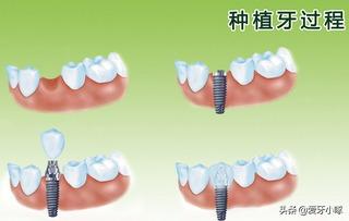 牙齿松动怎么办最有效的方法,牙齿松动怎么办教你一招搞定