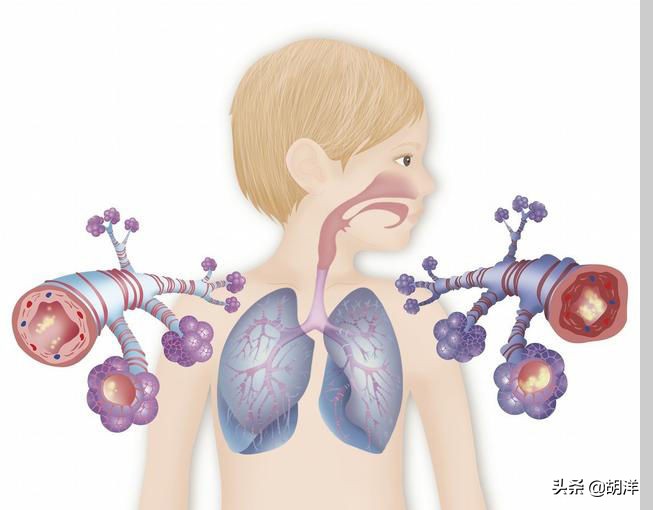 哮喘反复发作多半是没有坚持治疗,治疗哮喘过程中反复发作