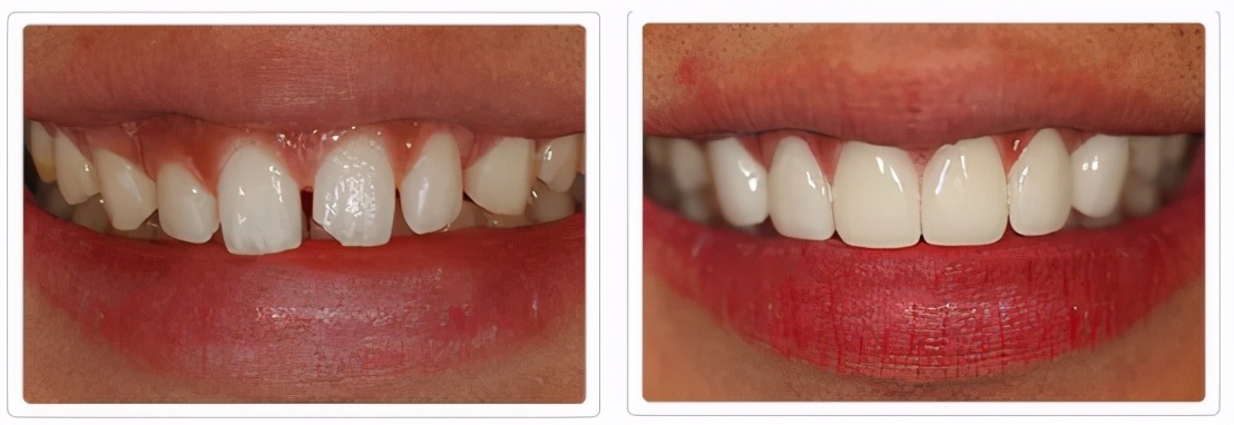 一口黄牙怎么办？10年牙科医生教你怎么拥有一口亮白美牙