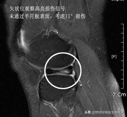 怎样能看懂膝关节核磁图片,如何看懂膝关节磁共振报告