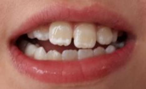 牙齿长白点到底是不是脱矿,牙齿出现白点该怎么办