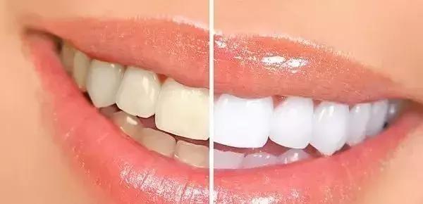 牙齿发黄变白小窍门,小孩牙齿发黄是什么原因如何去除